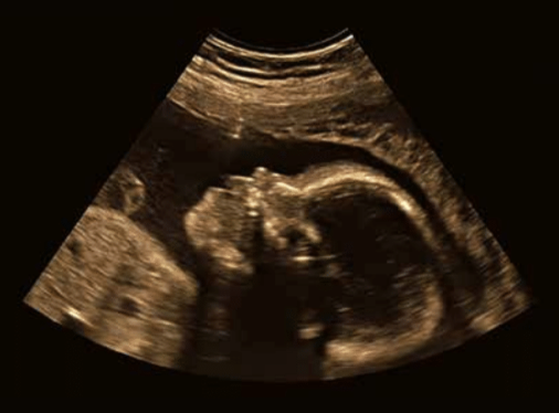 Ultrasound image